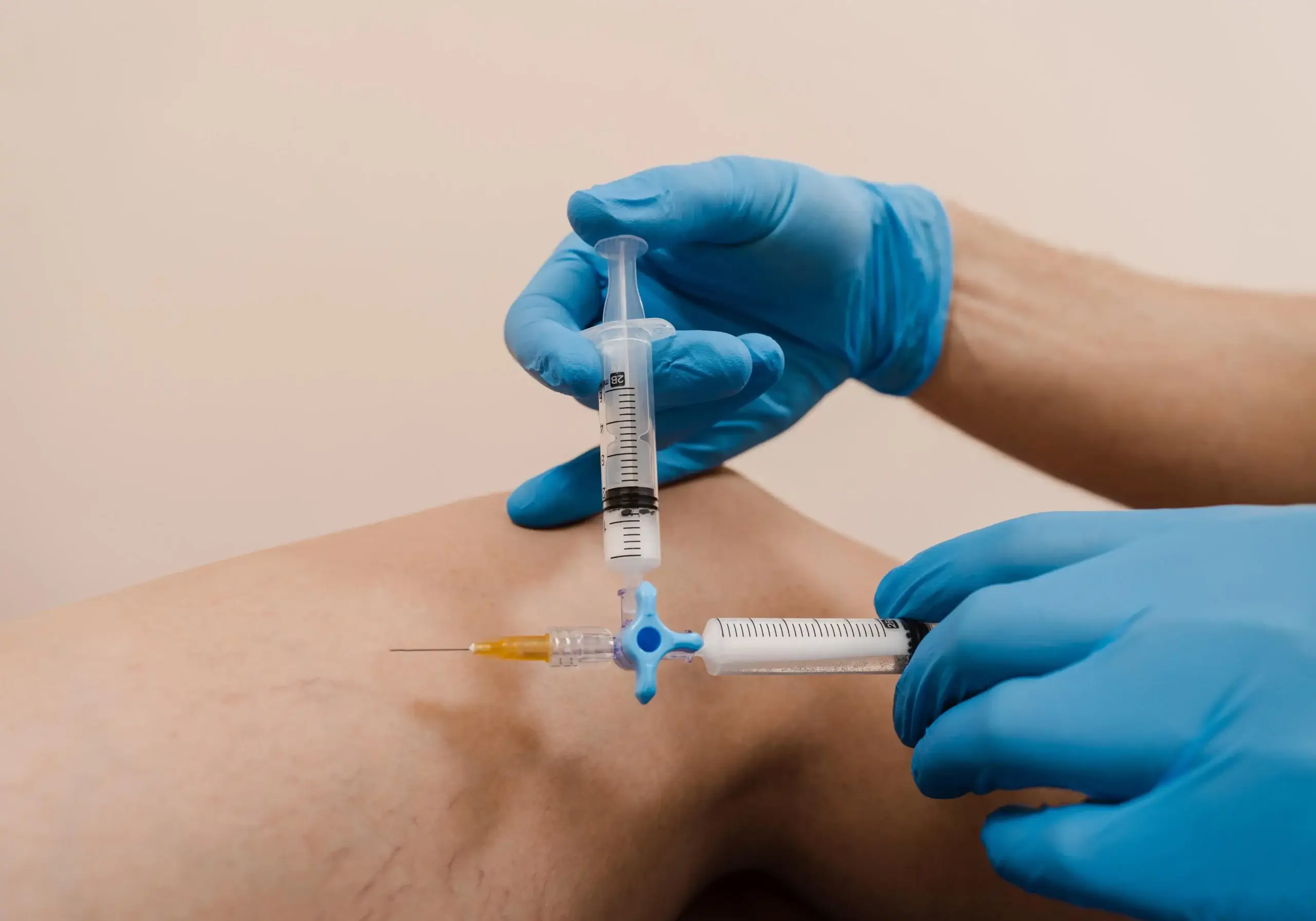 Sklerosierung von Besenreisern