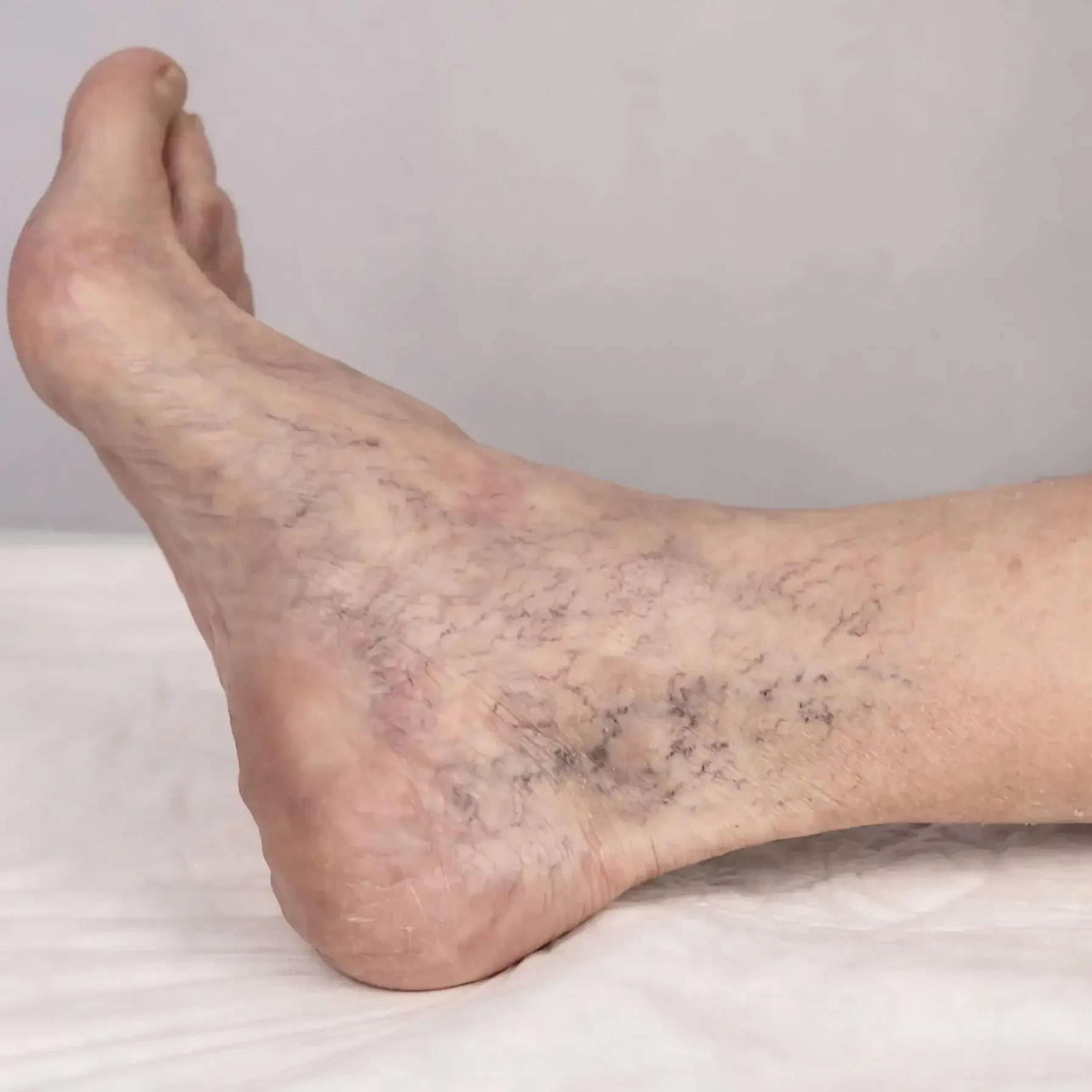 Sklerosierung von Besenreisern