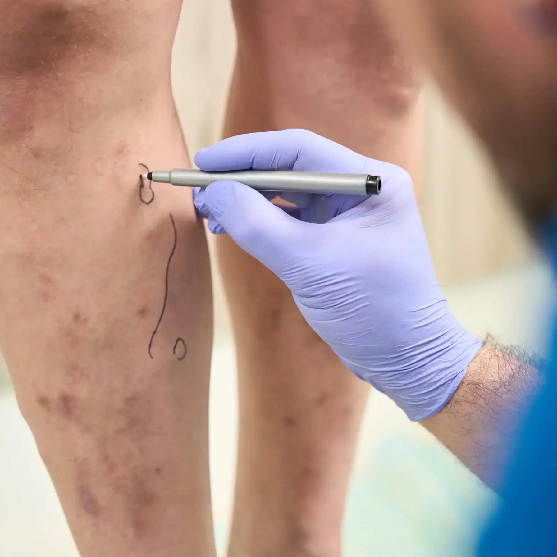 Sklerosierung von Besenreisern